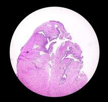 Histology of urachal cyst. Photomicrograph of histological stained slide showing Urachal cyst. Urethral cyst. photo