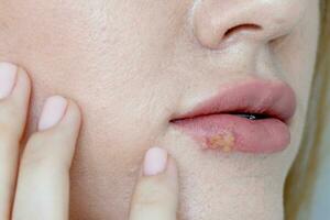 The woman with a virus herpes on lips photo