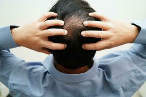 calvo cabeza en hombre, pelo pérdida tratamiento salud problema. foto