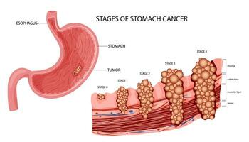 estómago cáncer. etapas crecimiento maligno canceroso tumor. anatómico vector ilustración aislado blanco antecedentes dibujos animados estilo