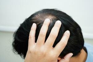 Bald head in man, hair loss treatment health problem. photo
