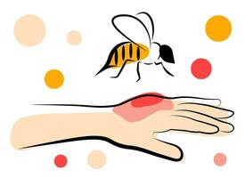 The bee bit his hand. Allergy vector