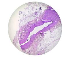 Photomicrograph, Prepatellar region histology showing Bursitis, acute or chronic Bursitis. photo