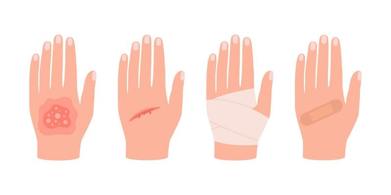 Physical injury human hand with burn of skin, open cut, bleeding wound. First aid clean bandage and patch. Vector illustration