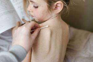 Little girl sitting with her back to camera and looking at treatment of ulcers from chickenpox photo