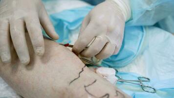 operaciones en el venas, en el piernas. un médico con un asistente en estéril quirúrgico vestidos realiza un operación en un del paciente pierna durante un operación. foto