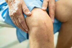 asiático mayor mujer paciente espectáculo su cicatrices quirúrgico total rodilla articulación reemplazo sutura herida cirugía artroplastia en cama en hospital. foto
