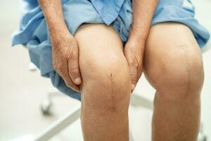 Asian elderly woman patient show her scars surgical total knee joint replacement Suture wound surgery arthroplasty on bed in hospital. photo