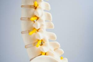 Lumbar spine displaced herniated disc fragment, spinal nerve and bone. Model for treatment medical in the orthopedic department. photo