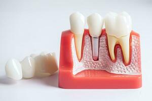 dental implante, artificial diente raíces dentro mandíbula, raíz canal de dental tratamiento, goma enfermedad, dientes modelo para dentista estudiando acerca de odontología. foto
