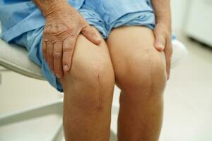 Asian elderly woman patient with scar knee replacement surgery in hospital. photo