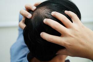 calvo cabeza en hombre, pelo pérdida tratamiento salud problema. foto