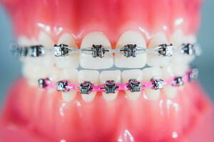 The braces are placed on the teeth in the artificial jaw. Macro photography photo