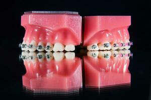 The braces are on the teeth in the artificial jaw on a black background. Macro photography photo