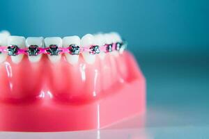 Braces are placed on the teeth in the artificial jaw against a light blue background. Macro photography photo