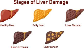 Set of flat vector illustrations on the theme of medicine. Stages of liver diseases.