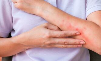 Close up of woman arm scratch the itch by hand at home, itching due to rash, fungus, allergy, dermatological disease, dry skin. Healthcare and medical concept. photo