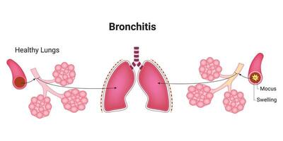 bronquitis Ciencias diseño vector ilustración diagrama