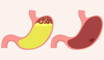 Cartoon illustration Gastric diseases, medical. vector