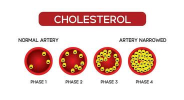 colesterol en artería, salud riesgo , hdl y ldl en artería, colestano prueba vector