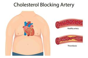 aterosclerosis concepto, salud riesgo. humano corazón. médico vector