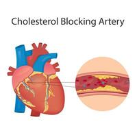 Healthy and narrowed blood vessels with accumulation of cholesterol plaques. The artery is blocked by a clot of fat cells. Comparison of LDL and HDL lipoproteins. Medical cross-section vector