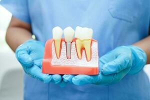 médico sostener dental implante, artificial diente raíces dentro mandíbula, raíz canal de dental tratamiento, goma enfermedad, dientes modelo para dentista estudiando acerca de odontología. foto