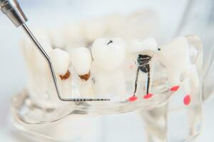 doctor orthodontist shows the instrument on caries in the teeth photo