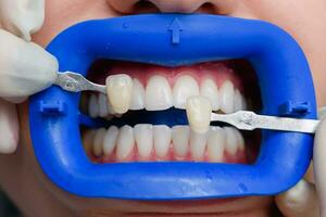 procedure for comparing the color shades of teeth with tests after bleaching photo