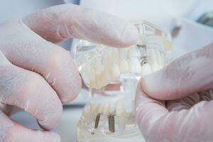 the orthodontist holds a model of teeth with implants in his hand and shows how to insert the tooth. Close up. Macro photo