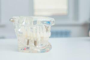 A model of teeth with implants lies on a table photo