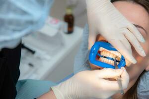 Preparing the oral cavity for whitening with an ultraviolet lamp. Close-up photo