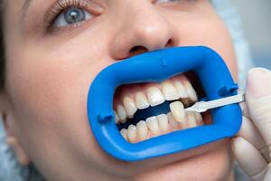 procedure for comparing the color shades of teeth using tests before bleaching photo