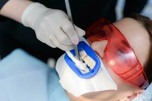 Preparing the oral cavity for whitening with an ultraviolet lamp. Close-up photo