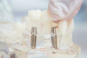 Orthodontist shows how to insert the implant. Macro photo