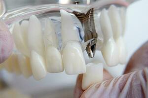 the orthodontist holds a model of teeth with implants in his hand and shows how to insert the tooth. Close up. Macro photo