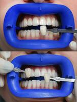 el procedimiento para comparando el color sombras de dientes antes de y después blanqueamiento foto