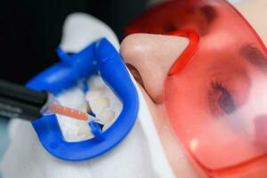 Preparing the oral cavity for whitening with an ultraviolet lamp. Close-up photo