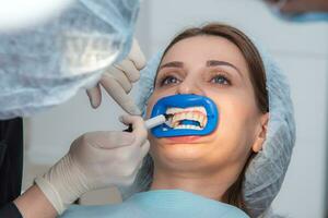 Preparing the oral cavity for whitening with an ultraviolet lamp. Close-up photo