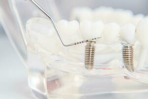 un modelo de dientes con implantes mentiras en un mesa foto
