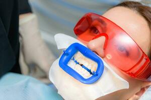 Preparing the oral cavity for whitening with an ultraviolet lamp. Close-up photo