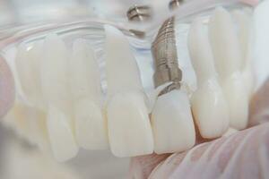 A model of teeth with implants lies on a table photo