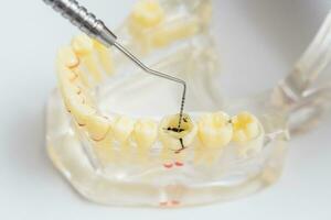 doctor orthodontist shows the instrument on caries in the teeth photo