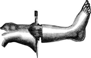 Amputation of the leg by the method has two flaps circular incision and formation of the first flap, vintage engraving. vector