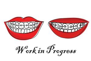 Braces and Retainers concept. vector