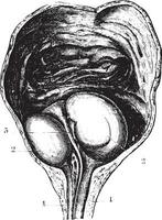 Enlarged prostate or Benign prostatic hyperplasia BPH, determi vector