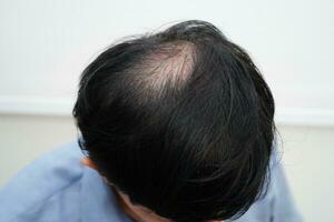 calvo cabeza en hombre, pelo pérdida tratamiento salud problema. foto