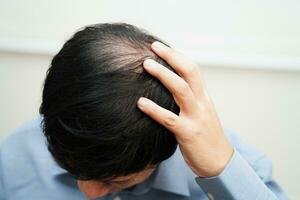 calvo cabeza en hombre, pelo pérdida tratamiento salud problema. foto