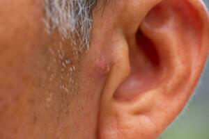 Close-up view of nodular acne in front of Asian elderly man ear. photo