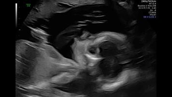 winzig weiblich Baby Rollen Über im Mutter Abdomen. Baby im Gebärmutter bewegt sich während Ultraschall video